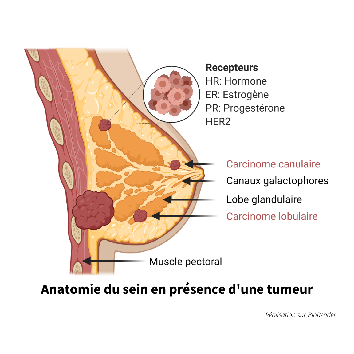 anatomie d'un sein en présence d'une tumeur