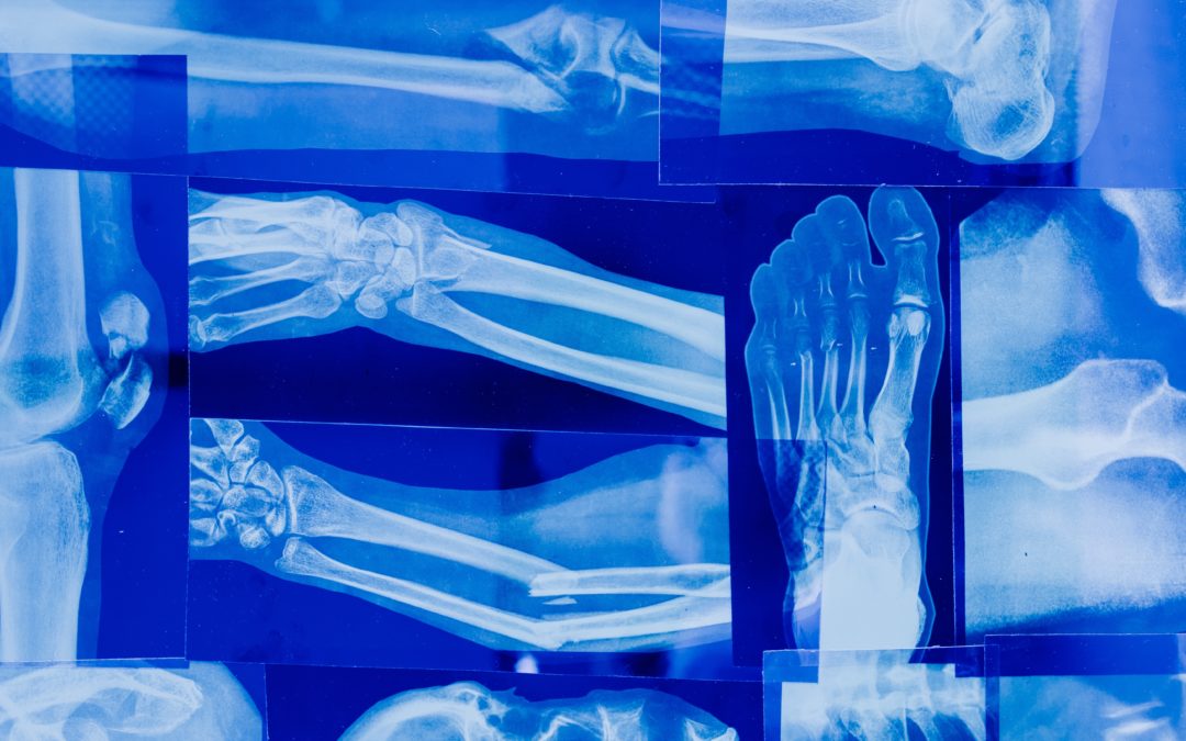 Les traitements de l’ostéoporose : de quoi parle-t-on ?