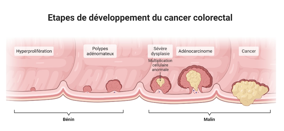 Etapes de développement du cancer colorectal